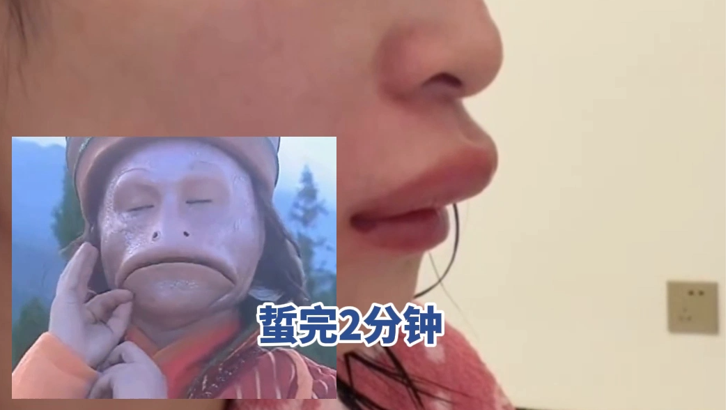 新娘婚礼前被马蜂蜇伤 自嘲像蛤蟆精