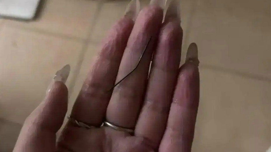 女子左臀疼1个月挤出发黑注射针头